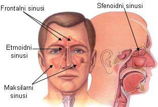 sinusitis2