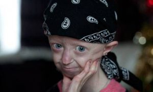hayley-bolest-djevojcica-progerija2