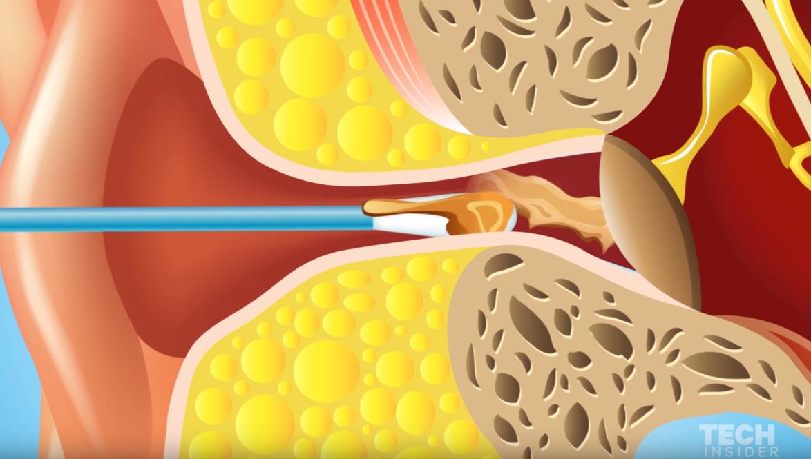 Evo šta se tačno dešava kada čistite uši štapićima? (VIDEO)