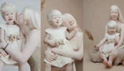 Albino sestre oduševile svijet svojom ljepotom