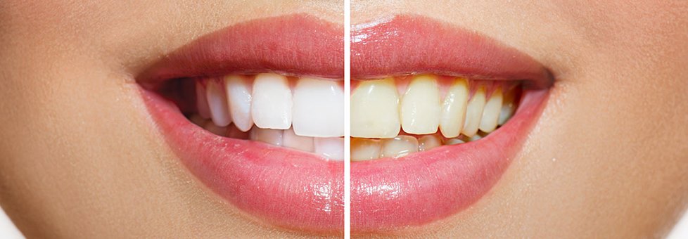 Stomatologinja tvrdi: Ljudi tokom dana čine tri pogreške zbog kojih zubi žute