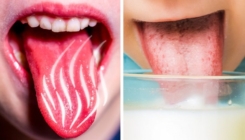 Opržili ste jezik vrućom hranom? Donosimo deset prirodnih načina za brzi oporavak jezika