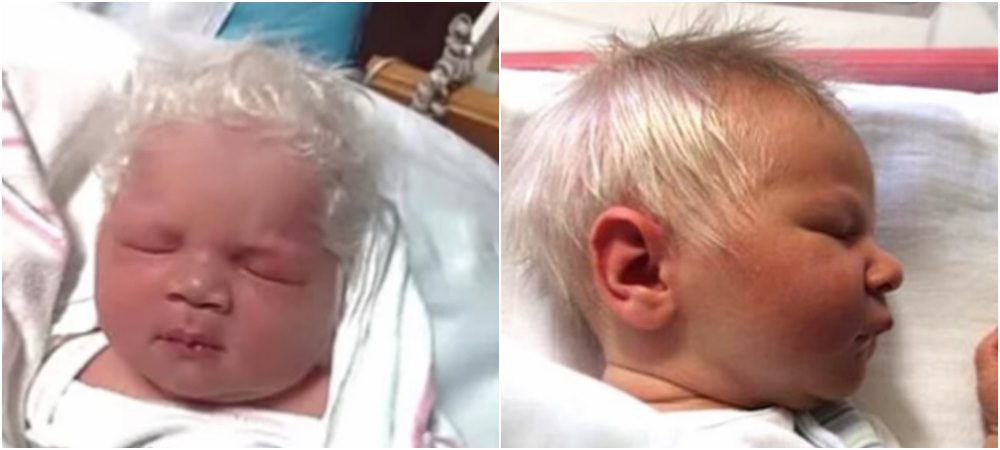 Medicinski fenomen: Rođena beba sa bijelom kosom, ali nema albinizam