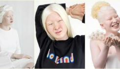 Napuštena albino beba postala je model Voguea