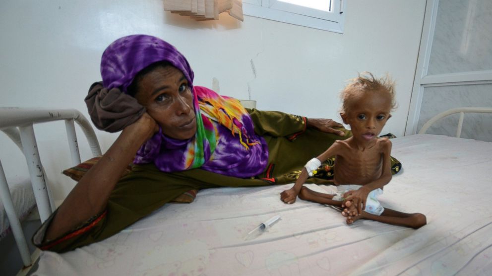 WHO: U Jemenu 75 posto djece pati od akutne pothranjenosti