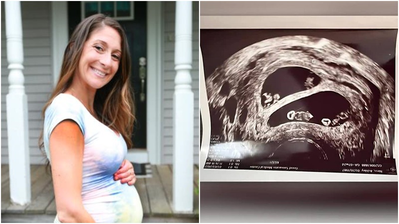 Mama četvero djece doživjela šok na ultrazvuku: Šanse za ovakvo nešto su 1 na 70 miliona