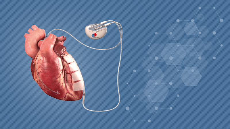 Na KCUS prvi slučaj ugradnje uređaja za mikrostrujnu terapiju srca