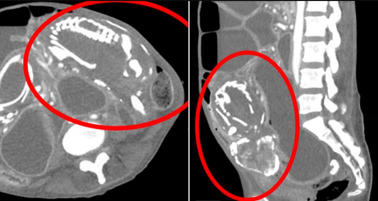 Žena preminula nakon što je otkriveno kako je čak devet godina nosila kalcificirani fetus u svom stomaku