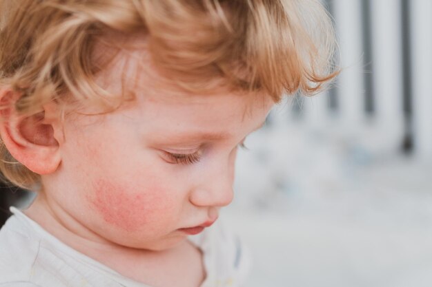 Atopijski dermatitis kod djece: Koji su simptomi i kako ga prepoznati?