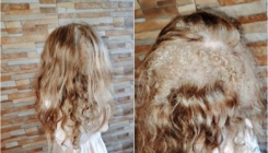Ljekari ne znaju uzrok pojave: Djevojčica iz Leskovca ima tri godine i rastu joj tri vrste kose