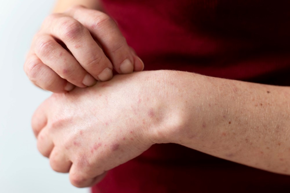 Alergija na sunce: Kako se tretira, koje opasnosti može izazvati?